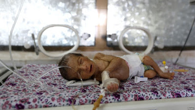Infants in War-torn Yemen Dying at Alarmingly High Rate