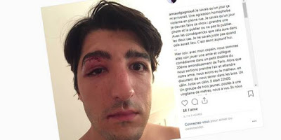 Après une agression homophobe à Paris devant un théâtre, ce comédien publie une photo de son visage tuméfié